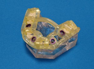 インプラントサージカルガイド