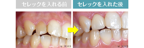 セレックと通常のセラミックの違い　イメージ写真