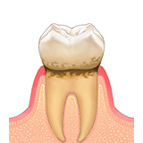 歯周炎