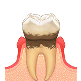 軽度歯周炎