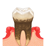 中等度歯周炎