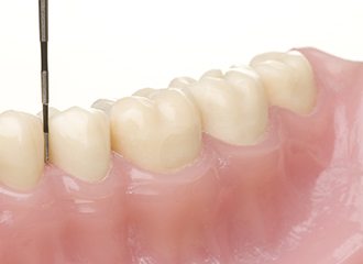 進行した歯周病には外科手術　イメージ写真